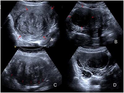 Sonographic features of uterine fibroids that predict the ablation rate and efficacy of high-intensity focused ultrasound